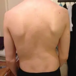 teen male back showing scoliosis