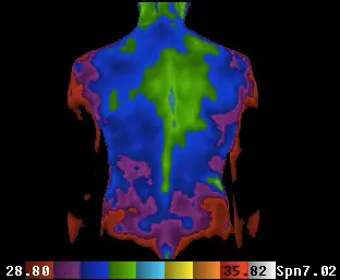 thermal scan scoliosis