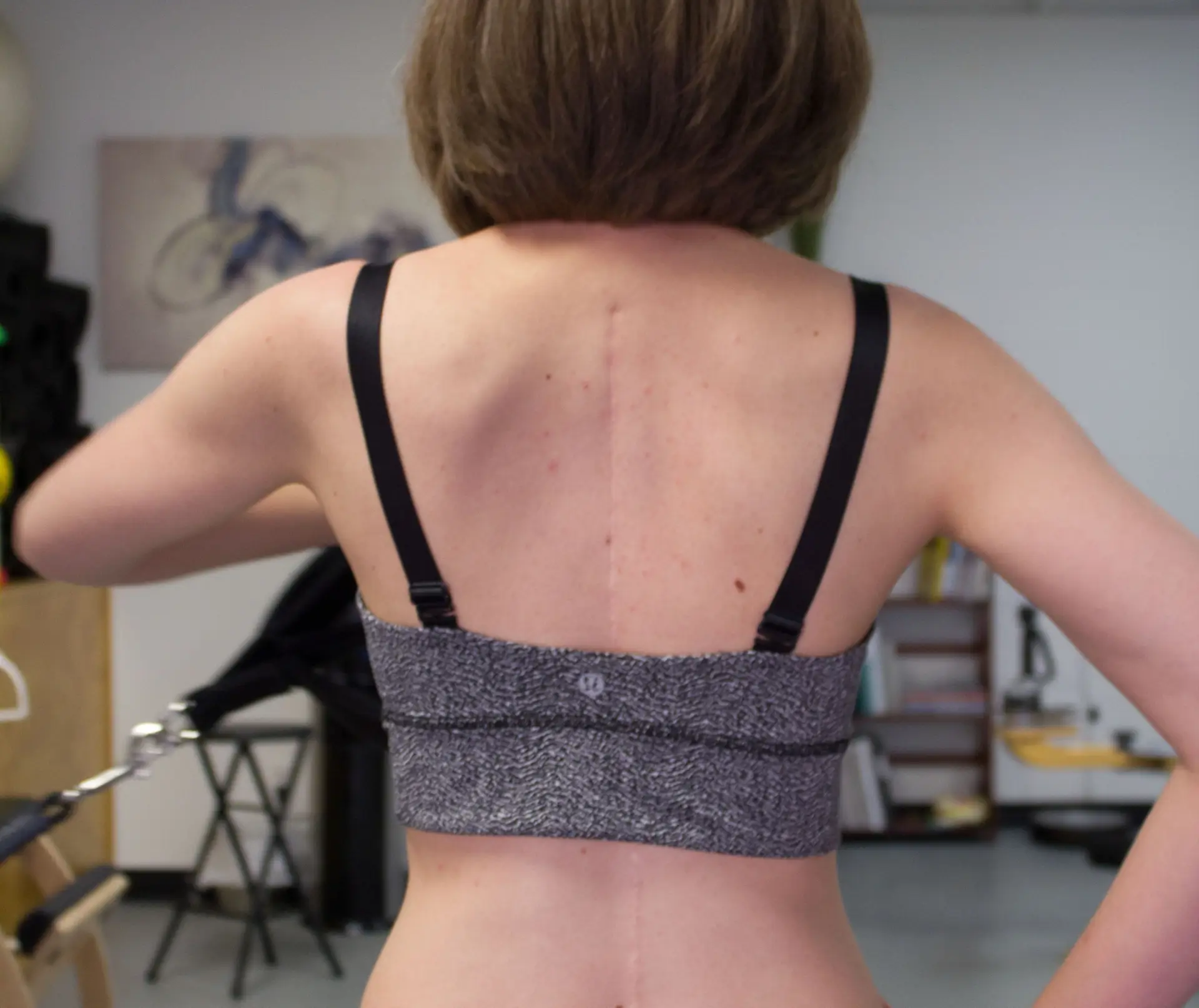 Scoliosis in adults treatment at Spiral Spine Nashville