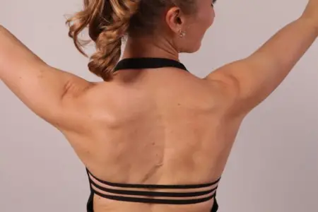 back of a white woman showing her scoliosis