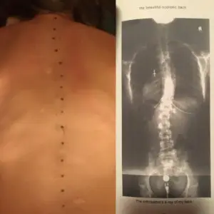 side by side of back with dots tracking scoliosis curve and xray