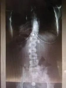 xray of scoliosis