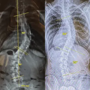 xray scoliosis improvement virtual care