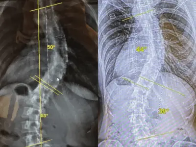 xray scoliosis improvement virtual care