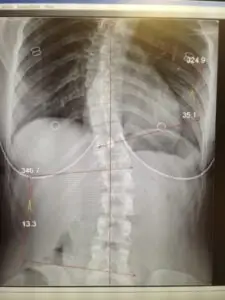 scoliosis x-ray with cobb angle measurements