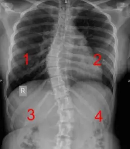 scoliosis x-ray showing concave vs. convex curves