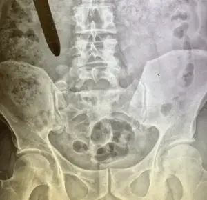 scoliosis x-ray of congenital scoliosis