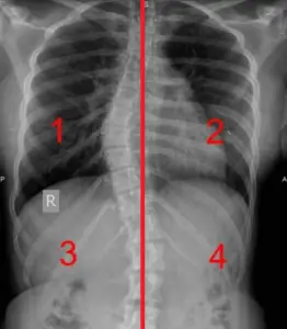 scoliosis x-ray with concave and convex notes and midline drawn